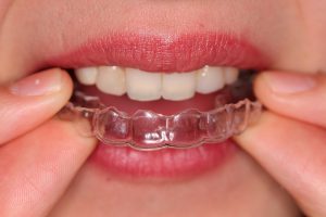 ortodoncia-invisible-clinica-arco-2